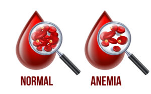 What Anemia Is and How Diet Helps in Recovery?